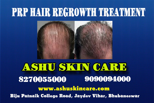 best prp hair regrowth treatmetnt in bhubaneswar near me